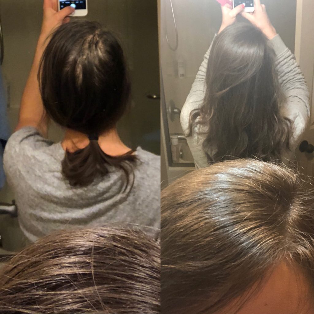 My experience with telogen effluvium, or extreme postpartum hair loss. I share my story, tips for dealing with pp hairloss and how using Amandean marine collagen helped my hair grow back after having a baby! #postpartum #postpartumhairloss #collagen #telogeneffluvium