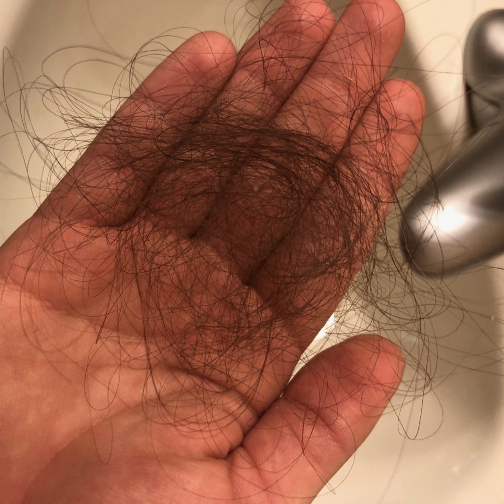 My experience with telogen effluvium, or extreme postpartum hair loss. I share my story, tips for dealing with pp hairloss and how using Amandean marine collagen helped my hair grow back after having a baby! #postpartum #postpartumhairloss #collagen #telogeneffluvium